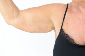The arms seem to get more flabby as you lose weight, and even very toned people seem to struggle with flabby arms. Here are 8 ways to reduce flabby arms.